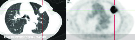 Early treatment option for lung cancer&nbsp;patients